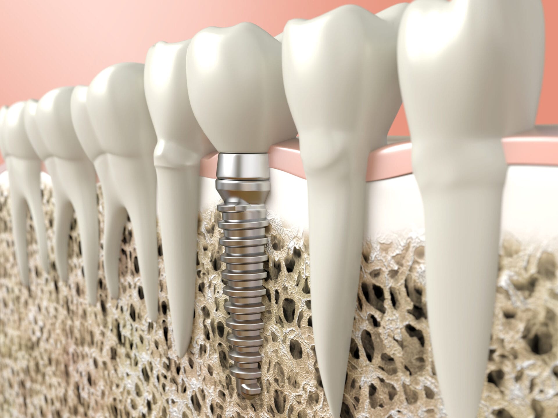 Dental implant among natural teeth.