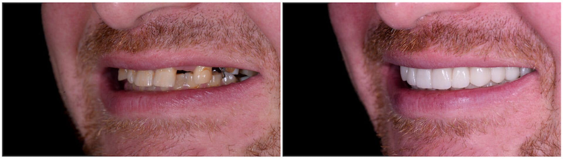Before and after comparison of a dental implant transformation at Carlsbad Shores Dentistry, showcasing a restored, healthy smile.